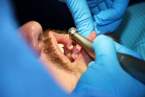 wisdom tooth extractions