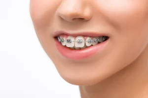 Braces for Teeth in Dubai