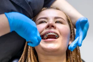 Teeth Braces